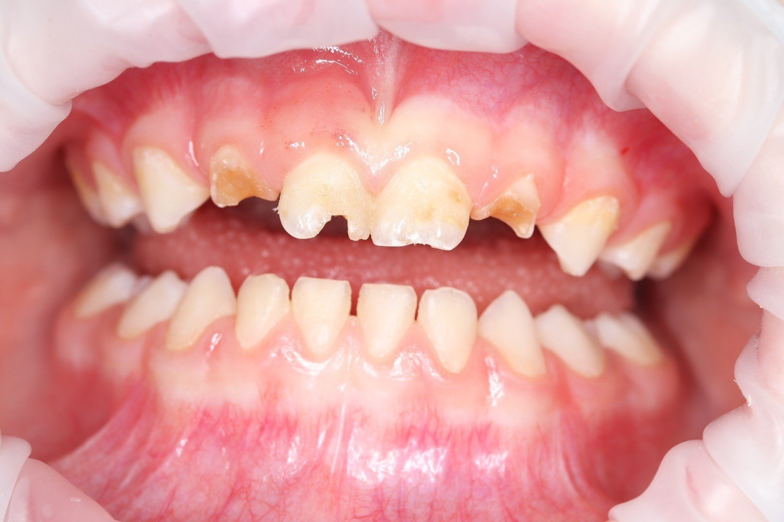 lechenie-molochnyh-zubov_1 lechenie-molochnyh-zubov_1